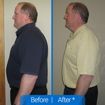 a man's result of Chirothin Weight Loss In Metairie