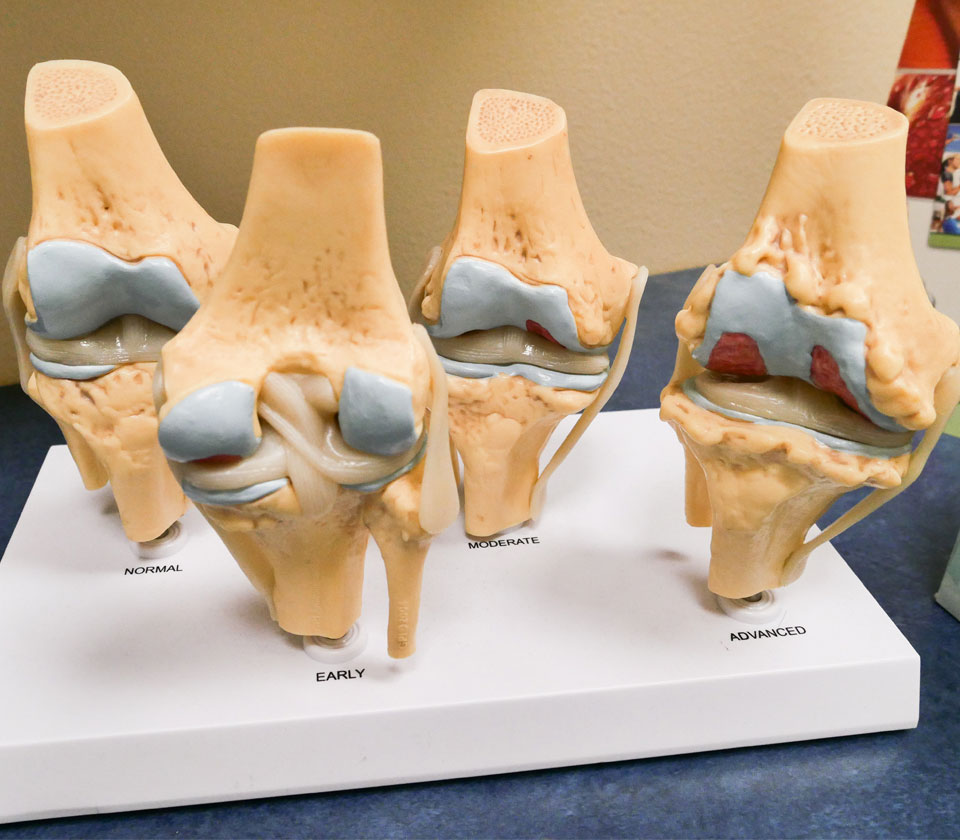 A demonstration of a bone condition at Superior Healthcare, Integrative Medicine and Chiropractor